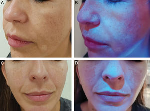 A) Melasma facial (mejilla). B) Realce de las zonas hiperpigmentadas con luz de Wood. C) Melasma facial (mejillas y labio superior). D) Zonas hiperpigmentadas con luz de Wood.