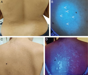 A) Hipomelanosis macular progresiva. B) Fluorescencia roja en los folículos de las zonas hipopigmentadas con luz de Wood (en la realidad es más fácil de apreciar que en la fotografía). C) Pitiriasis versicolor clínicamente muy sutil. D) Fluorescencia amarillenta con luz de Wood.