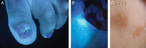 A) Síndrome de la uña verde por Pseudomona aeruginosa. B) Surcos acarinos con luz de Wood (flechas blancas). C) Imagen dermatoscópica de los surcos acarinos (flechas blancas).