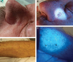 A) Carcinoma basocelular mal delimitado en la zona paranasal izquierda. B) Delimitación prequirúrgica con luz de Wood. C) Cicatriz de melanoma en el antebrazo derecho, previa ampliación de márgenes. Difícil de detectar clínicamente. D) La luz de Wood permite encontrar fácilmente la cicatriz (flechas negras).