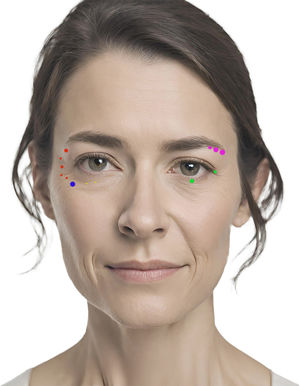 Lado izquierdo con los puntos de infiltración músculo orbicular de los párpados para el tratamiento de las arrugas de los cantos externos. Puntos clásicos (rojo), punto del borde inferior (azul) y puntos de las arrugas del párpado inferior (amarillos). Lado derecho con puntos para la elevación de la ceja (puntos rosas) y los puntos para la apertura ocular (puntos verdes).