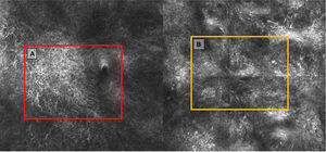 Confocal microscopy. A) Epidermis with an atypical honeycomb appearance and numerous dendritic cells, many of which are perifollicular in location. B) Disorganized dermoepidermal junction with atypical junctional thickening and abundant atypical cells.