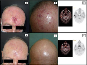 Patient #6 (a-b): local recurrence in the region of the scar from as previously surgically treated MCC. Image A shows an infiltrated and erythematous skin around the scar (the patient also had loco-regional lymph node involvement). Recurrence was histologically confirmed. Image B shows the complete disappearance of previous lesions, with full closure of the scar and absence of MCC lesions after 5 cycles of avelumab. Patient #2 (c-d): loco-regional recurrence in the form of multiple satellitosis in a patient with a past medical history of primary MCC on the scalp. Image C shows multiple erythematous-violet papules and nodules corresponding to loco-regional cutaneous metastases (the patient also exhibited loco-regional lymph node involvement). Image D shows the complete disappearance of all cutaneous lesions after 7 cycles of avelumab plus loco-regional adjuvant radiotherapy. Patient #2 (e-f): comparative axial views of PET/CT images at cervical level. Image E shows 2 hypermetabolic nodular lesions on the PET scan, corresponding to metastatic lymphadenopathy. Image F shows the disappearance of these lesions after 7 cycles of avelumab. MCC: Merkel cell carcinoma; PET/CT: positron emission tomography/computed tomography.