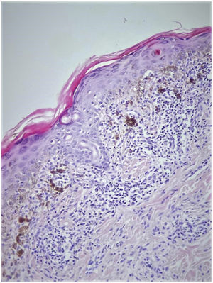 Cuerpo citoide (flecha) en la epidermis, infiltración linfocítica de tipo banda (asterisco) en la dermis superior, e incontinencia pigmentaria intensa (×200 HE).