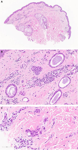 A) Punch cutáneo que muestra una proliferación epitelial ductal de características benignas, localizada únicamente en dermis superficial. Se observa fibrosis estromal circundante, así como un infiltrado inflamatorio de patrón perivascular y perianexial (H&E panorámica). B) A mayor aumento, la lesión se compone de nidos y ductos formados por una o varias capas de células cuboidales de talla pequeña, sin atipia (H&E ×20). C) Ocasionalmente pueden adoptar un patrón tadpole like (H&E ×50).