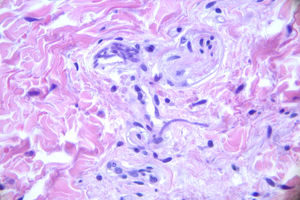 Grupo de hifas hialinas y septadas en localización intravascular y en la dermis inmediatamente adyacente al vaso. Tinción de hematoxilina-eosina.