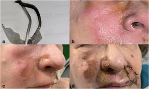 Caso deflagración en cirugía dermatológica facial. a) Cánula nasal carbonizada. b) Estado inmediato tras quemadura. c) Evolución a los 7 días. d) Evolución a los 14 días.