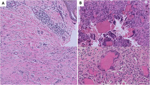 Tinción con hematoxilina-eosina. A) Fibrosis superficial cicatricial, sin signos de vasculitis ni vasculopatía trombótica (10x). B) Reacción gigantocelular a cuerpo extraño (20x superior, 40x inferior).