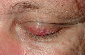 Erythematous lesion on the left upper eyelid with tortuous vessels (patient #1).