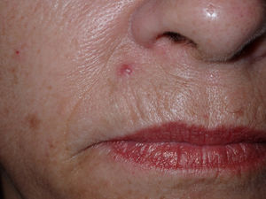 Erythematous papule on the upper lip (patient #2).