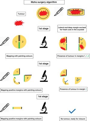 Mohs surgery algorithm.