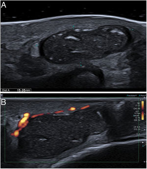 Ecografía de alta resolución del aspecto posterior del codo. Lesión de 15mm, predominantemente quística y bien definida. Es anecoica en la periferia con contenido heterogéneo y zonas ecoicas focales internas sugestivas de queratina (A). La lesión parece avascular, sin vasos internos evidentes (B).