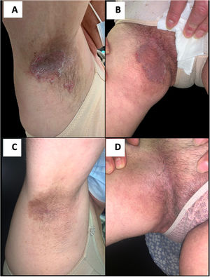 Placas pardo-rojizas con erosiones superficiales y aspecto macerado, localizadas en los pliegues axilares (A) e ingle (B) antes de iniciarse el tratamiento con apremilast. Obsérvese la mejora de las lesiones transcurridos 6 meses de tratamiento con 30mg de apremilast dos veces diarias (C y D).