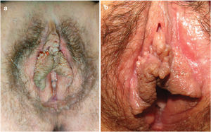 Linfangioma circunscrito vulvar. Papulovesículas traslúcidas, coalescentes, no inflamatorias y de tamaño milimétrico en la pared externa superior de los dos labios mayores, formando dos placas papilomatosas. También puede identificarse una vesícula con sangrado intraquístico (A).