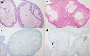 Hallazgos microscópicos de linfangioma circunscrito. (A y B) Examen histopatológico que revela la presencia de una lesión polipoide con proliferación vascular cutánea y vasos dilatados compuestos por una capa única de células endoteliales (ver flechas). (C) Positividad parcheada para D2-40. (D) Receptores de progesterona expresados por las células estromales.