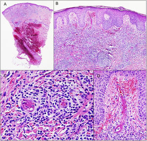 La biopsia reveló la presencia de infiltrado inflamatorio denso en la dermis superficial y media, compuesto principalmente de linfocitos (A, B). Se observaron imágenes de vasculitis linfocítica, con tumefacción endotelial, oclusión trombótica luminal, depósito de fibrina y extravasación de glóbulos rojos (C, D).