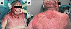 Ejemplo de una mujer de 53 años que acudió a la consulta de dermatología con necrólisis epidérmica tóxica relacionada con pembrolizumab para el cáncer de pulmón metastásico. El exantema fue predominante en el rostro, línea del cuello (panel A) y espalda superior (panel B). Los días siguientes las lesiones de la paciente progresaron hasta cubrir el 60% del área de superficie corporal.