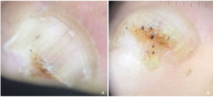 Caso 2. Dermatoscopia. (A) Cromoniquia amarilla y hemorragias en astilla en el 4° dedo del pie izquierdo. (B) Onicoscopia del borde libre que muestra engrosamiento de la lámina ungueal central, puntos negro-rojizos, y líneas sobre un fondo naranja. La parte ventral del tumor imita un pterigio ventral.