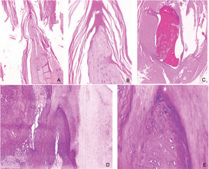 Caso 1. Patología. 10×, 40× y 40× (A, B, C, respectivamente). Matriz ungueal con estrato córneo hiperqueratósico asociado a paraqueratosis, focos hemorrágicos y exudado seroso. El estrato de Malpighi revela papilomatosis y cambios coilocíticos sutiles. Caso 2. Patología. 10× y 40× (D, E, respectivamente). Matriz ungueal con hiperqueratosis y paraqueratosis, Estrato de Malpighi con papilomatosis, hipergranulosis y cambios coilocíticos.