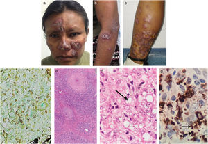 Placas eritematosas parduzcas en el rostro (A). Placas violáceas en el antebrazo y brazo izquierdos (B). Nódulos y gran placa de infiltrado eritematoso en la parte posterior inferior de la pierna izquierda, con zonas de ulceración(C). Estructuras de Gomori positivas dentro de los histiocitos (tricrómico de Gomori, 40×). (D) Proceso inflamatorio nodular granulomatoso con contenido de linfocitos, histiocitos y algunas células plasmáticas en la dermis superior y profunda (tinción HyE, 10×). (E) Amastigote de Leishmania, flecha (tinción HyE, 600×). (F) Inmunohistoquímica anti-CD68 (clon KP1) que muestra positividad citoplasmática intensa en los macrófagos. Además, pueden observarse algunos amastigotes, flechas (IHQ, 600×) (G).