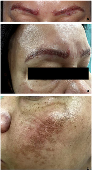 A and B) Erythematous-brownish papules and plaques on both eyebrows. C) Erythema on the left cheek surrounding a melasma.