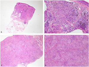 A and B) Biopsy of the eyebrow. Infiltration of the dermis by sarcoid granulomas. Presence of brownish pigment in the cytoplasm of some histiocytes. C and D) Hand biopsy. Hypodermis occupied by sarcoid granulomas.