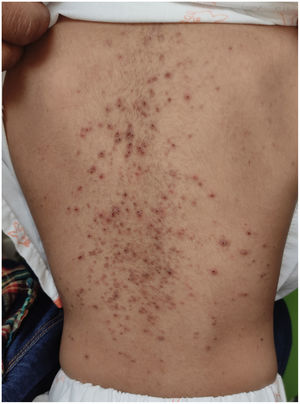 Cutaneous involvement with papulocrustous lesions on the trunk.