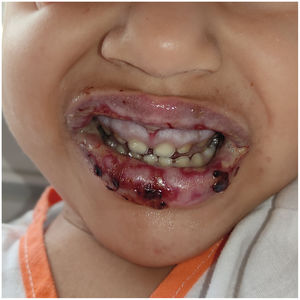 Oral involvement with edema, erosions, crusts on the lips, and gingivitis.