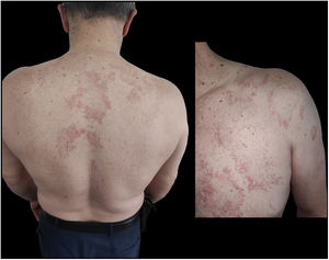 Clinical image: erythemato-xanthochromic papules on torso and upper limbs.