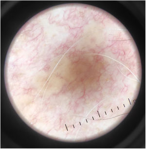 Dermoscopic findings: lesions with an apple jelly pattern, without a scaling collar.