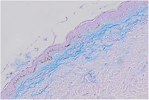 Histology: Alcian blue staining showing excess mucin in the upper dermis (x100).