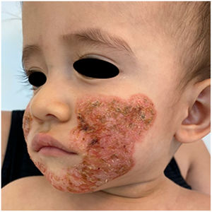 Compromised cheeks and chin, an irregular, well-demarcated, infiltrated, lichenified plaque with scaling and serohematic crusts.