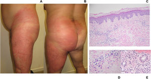 A: clinical image. Left lateral view. Large erythematous plaque covering the entire left thigh and ipsilateral flank. Well-demarcated, indurated, and warm plaque. B: clinical image. Posterior view. Erythematous-edematous plaque. Left thigh, buttock, and flank involvement; confluent toward the lumbosacral region. C: histological image. Overview. Skin with superficial perivascular lymphocytic inflammation with neutrophils. Mild papillary dermal edema and preserved epidermis. No evidence of panniculitis or vasculitis. No eosinophils seen. Original Image 4X. Hematoxylin-eosin stain. D: histological image. Detail of inflammatory infiltrate. Papillary dermis with perivascular lymphocytic infiltrate. Presence of neutrophils. Original Image 20X. Hematoxylin-eosin stain. E: histological image. Detail of periadnexal infiltrate. Periadnexal inflammatory infiltrate composed of lymphocytes and neutrophils. Original Image 20X. Hematoxylin-eosin stain.