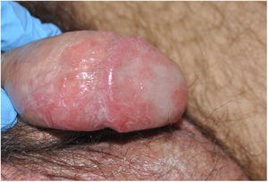 Circinate balanitis in the form of painless erythematous plaques and erosions with geographic borders (Case #1).