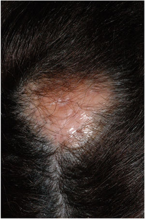 5cm2 yellowish, infiltrated, alopecic plaque on the left parietal area.