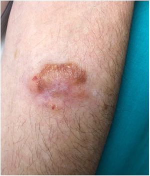 Lobulated, elastic plaque with a superficial blister, approximately 4cm2 in diameter located on the left forearm.