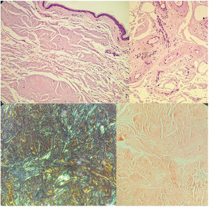 A and B) HE: deposit of amorphous eosinophilic material occupying the entire dermis, subcutaneous tissue, and around vessels, associated with a plasma cell infiltrate. C) Congo red: red-orange coloration. D) Polarized light: apple-green birefringence. HE: hematoxylin-eosin.