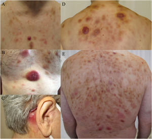 Espectro clínico de las lesiones cutáneas de la neoplasia de células dendríticas plasmocitoides blásticas. (a, b, d) Múltiples nódulos eritematosos con placas de aspecto contusiforme en el tórax y la parte superior de la espalda. (c) Lesión nodular eritematosa aislada en la zona retroauricular. (e) Placas eritematosas difusas en la espalda con presencia de lesiones nodulares violáceas dispersas.