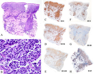 Hallazgos histológicos de biopsias cutáneas de neoplasia blástica de células dendríticas plasmocitoides. (A, B) Tinción de hematoxilina-eosina (A, ×20; B, ×400). Presencia de un denso infiltrado dérmico de células de tamaño intermedio con núcleos atípicos, con zona de Grenz y sin epidermotropismo ni tropismo vascular. (C) Tinción inmunohistoquímica (×2) positiva para CD4, CD56 y CD123, y negativa para CD3 y CD20. Presencia de un elevado número de mitosis (ki67>50%).