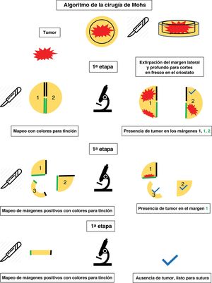 Algoritmo de la cirugía de Mohs.