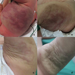 Imagen comparativa donde se observa la involución de la lesión: a) 3 días de vida; b) 18 días de vida; c) 6 meses de edad; d) 11 meses de edad.