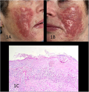 A-B)Imágenes clínicas previas al diagnóstico. Placas conformadas por pápulas eritematorrojizas con descamación leve superficial, con algunas pústulas sobre base eritematosa. C)Estudio histológico mediante tinción con hematoxilina-eosina que revela una epidermis acantósica con espongiosis, con agregados de neutrófilos intracórneos, hifas y esporas micóticas en el estrato córneo positivas con la técnica de PAS, y un denso infiltrado linfoplasmocitario en banda en la dermis subyacente.