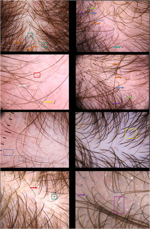 Trichoscopic findings in patients with LAHS. Vellus hairs (blue arrow), scales (red arrow), cadaveric hair (light green arrow), exclamation hair (yellow arrow), bended hair (white arrow), “dirty dots” (orange arrow), pigmented network (light purple arrow), dystrophic hair (dark green arrow), color dots (red and blue) (dark purple arrow), fragments of hair shaft out of its follicle (yellow rectangle), transverse bright bands (blue rectangle), flame hair (red rectangle), granular rectangular structures (green rectangle), coiled proximal hair (purple rectangle), and perifollicular hyperkeratosis (grey rectangle).