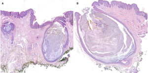 A y B)Histopatología (tinción H&E); magnificación A: ×20, magnificación B: ×40. Se observa la porción superficial infundibular ligeramente dilatada y quistificada con leves cambios fibróticos e inflamatorios en la dermis subyacente. Estos hallazgos son compatibles con una hidradenitis supurativa.