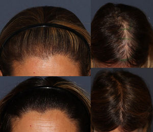 Hair transplant in 2 of the patients. Results before (upper region) and 12 months after surgery (lower region) in the frontal and interparietal combing areas.