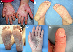 A) Placa eritematoescamosa con costras hemáticas y fisuras en las palmas y los dedos de ambas manos. B) Placas queratósicas blanco-amarillentas en las plantas y los dedos de ambos pies con fisuras y costras hemáticas. C) Placas queratósicas blanco-amarillentas en las plantas que se extienden hacia los dedos con presencia de fisuras. D) Placas queratósicas blanquecinas en las palmas y los dedos con presencia de fisuras y costras hemáticas. E) Placa eritematodescamativa en la región distal del primer dedo de la mano izquierda con fisuras y compromiso periungueal y ungueal (cambio de coloración, estrías longitudinales, hoyuelos y distrofia ungueal).