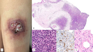 Linfoma de células grandes B difuso asociado al virus de Epstein Barr positivo, No especificado. (A) Imagen clínica que muestra placa indurada infiltrada eritemato-violácea en región superior de muslo derecho en paciente anciana. (B) Con un pequeño aumento se observa infiltrado dérmico en porción superficial y profunda, de patrón nodular (HE, 2X). (C) Con mayor aumento, el infiltrado es heterogéneo con presencia de células grandes de morfología atípica y hábito sternbergoide. (HE, 20X). Estas células son (D) positivas para CD30 (2X), (E) EBER (2X) y (F) CD20 (2X).