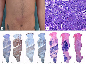 Proceso linfoproliferativo hydroa vacciniforme. (A-C) Imagen clínica de la cara de una paciente donde se observa importante edema malar y lesiones en forma de placas eritemato-violáceas, así como alguna pequeña cicatriz varioliforme de lesiones previas. (D-F) HE, 2X y 10X. A pequeño aumento se observa un punch cutáneo con infiltración linfoide superficial y profunda, con epidermotropismo. A mayor aumento se observa formación de vesículas espongióticas con necrosis de queratinocitos (E) así como infiltrados perianexiales (F). La población tumoral es positiva para CD2 (G, 10X), y EBER (H e I, 10X).