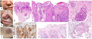 Linfoma de células T/NK extranodal. (A) En la imagen clínica destacan múltiples nódulos con centro necrótico y halo eritematoso distribuidos en tronco. (B) (HE, 2X): a pequeño aumento se observa un infiltrado dérmico en porción superficial y profunda, con relación a vasos (C, 4X) y anejos con epidermotropismo (D, 10X). A mayor aumento (E, 20X) este infiltrado se constituye por elementos atípicos de talla grande. Estas células son positivas para CD3 (F, 2X), CD56 (G, 2X) y EBER (H, 2X).