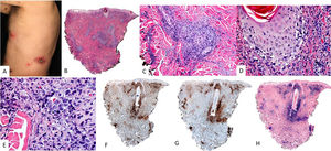 Linfoma de células T/NK cutáneo intravascular. (A) En la imagen clínica se muestran múltiples máculas y placas equimóticas distribuidas en tronco, algunas con distribución lineal o agrupada. (B) (HE, 2X): con un pequeño aumento se observa un infiltrado dérmico con afectación de vasos del plexo superficial y profundo. A mayor aumento (C,10X) este infiltrado se sitúa dentro de los vasos. Se halla constituido por elementos de talla grande atípicos, con marcado hipercromatismo nuclear. Estas células son negativas para CD20 (D, 4X); por el contrario, son positivas para CD3 (E, 4X) y EBER (F, 4X).